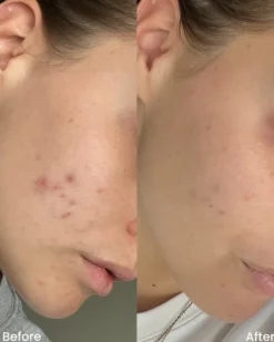 clay and glow spot treatment gel Gel