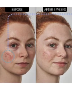 the inkey list supersolutions SUPERSOLUTIONS 10% AZELAIC ACID SERUM