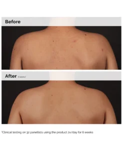 the ordinary signs of congestion SALICYLIC ACID 0.5% BODY SERUM